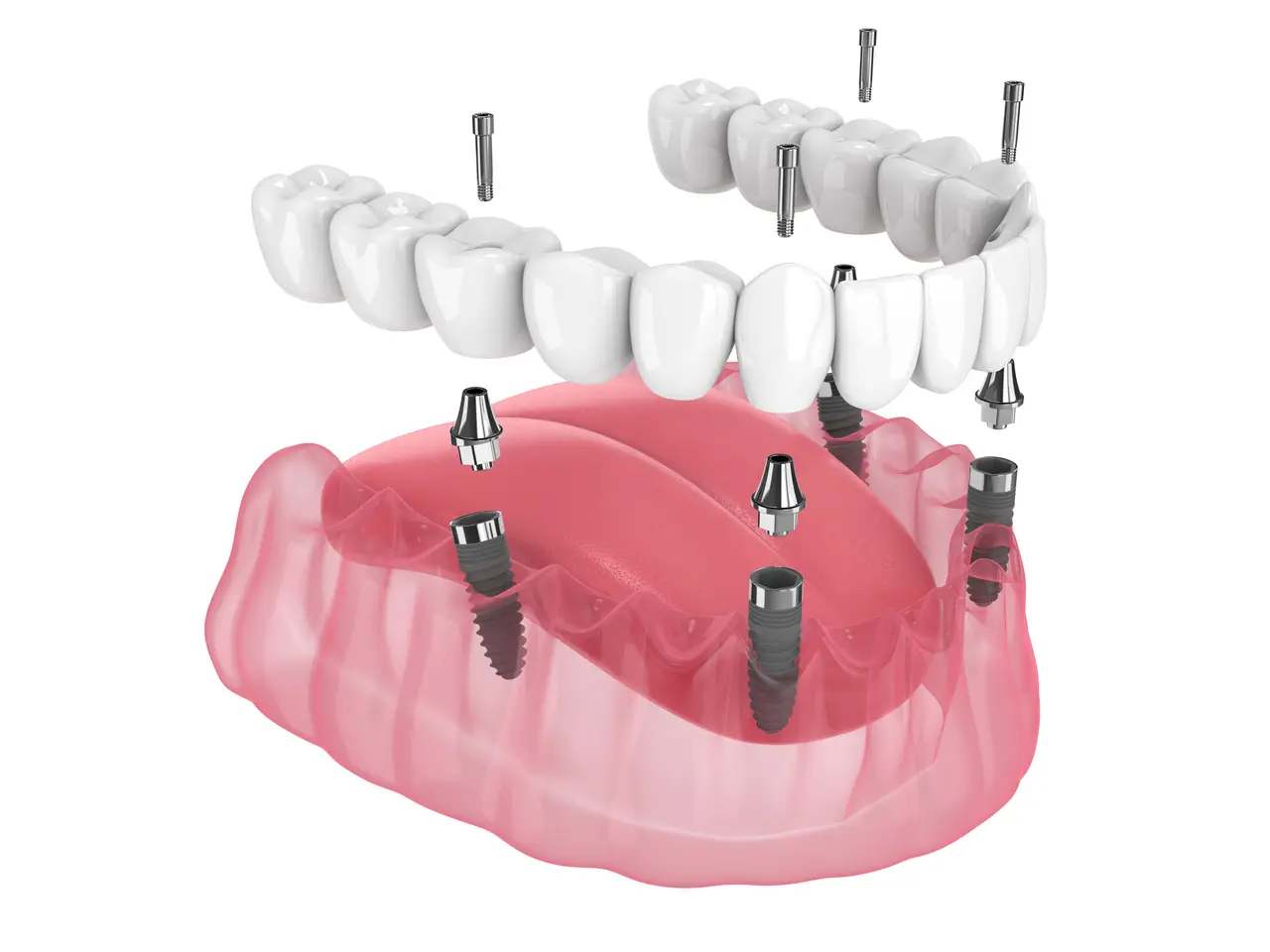 All-on-4 / All-on-X Implants at Terrell Hills Dental in San Antonio