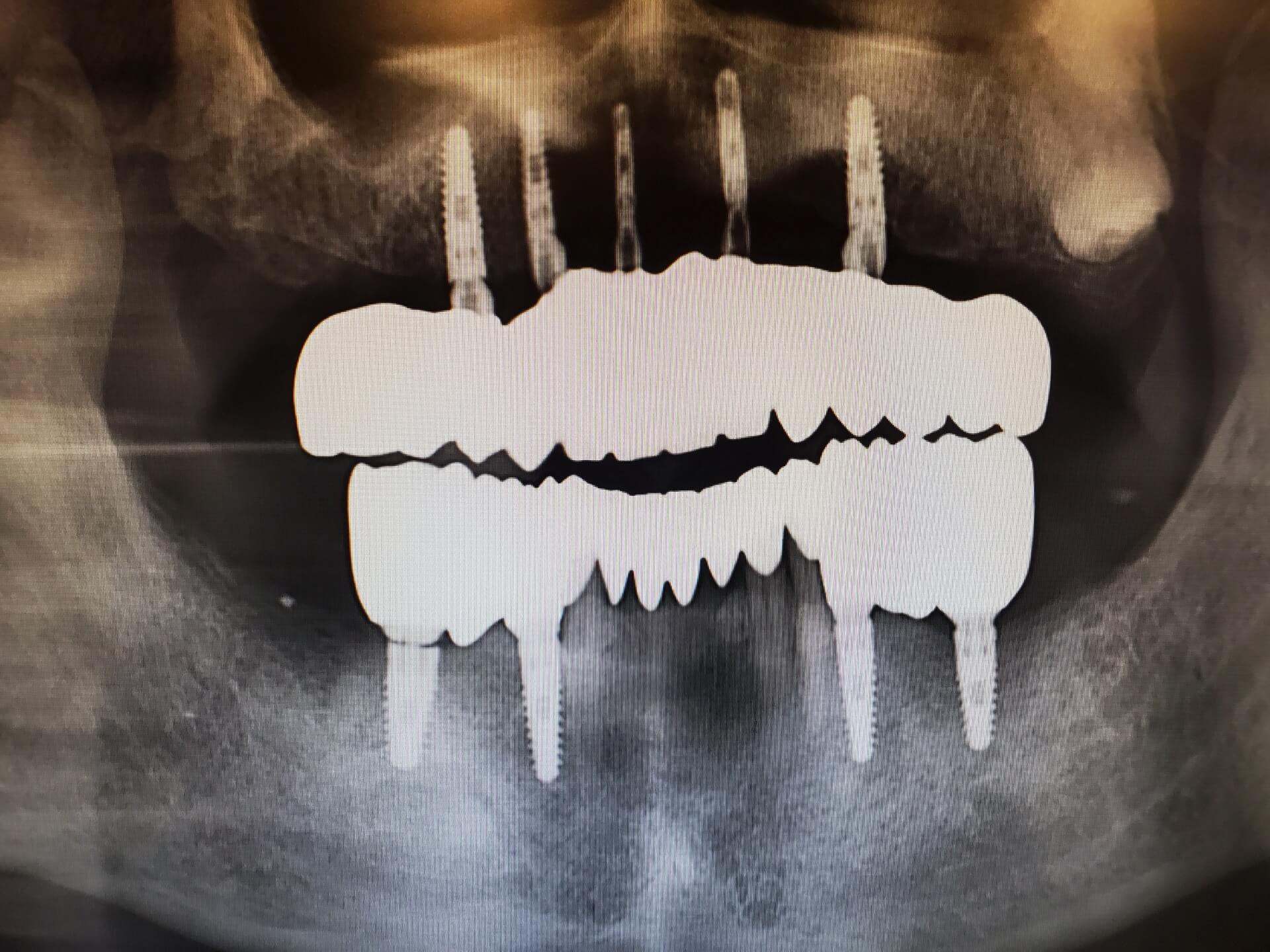 All-on-X full-arch implant bridge case 1 — before and after treatment at Terrell Hills Dental in San Antonio, TX