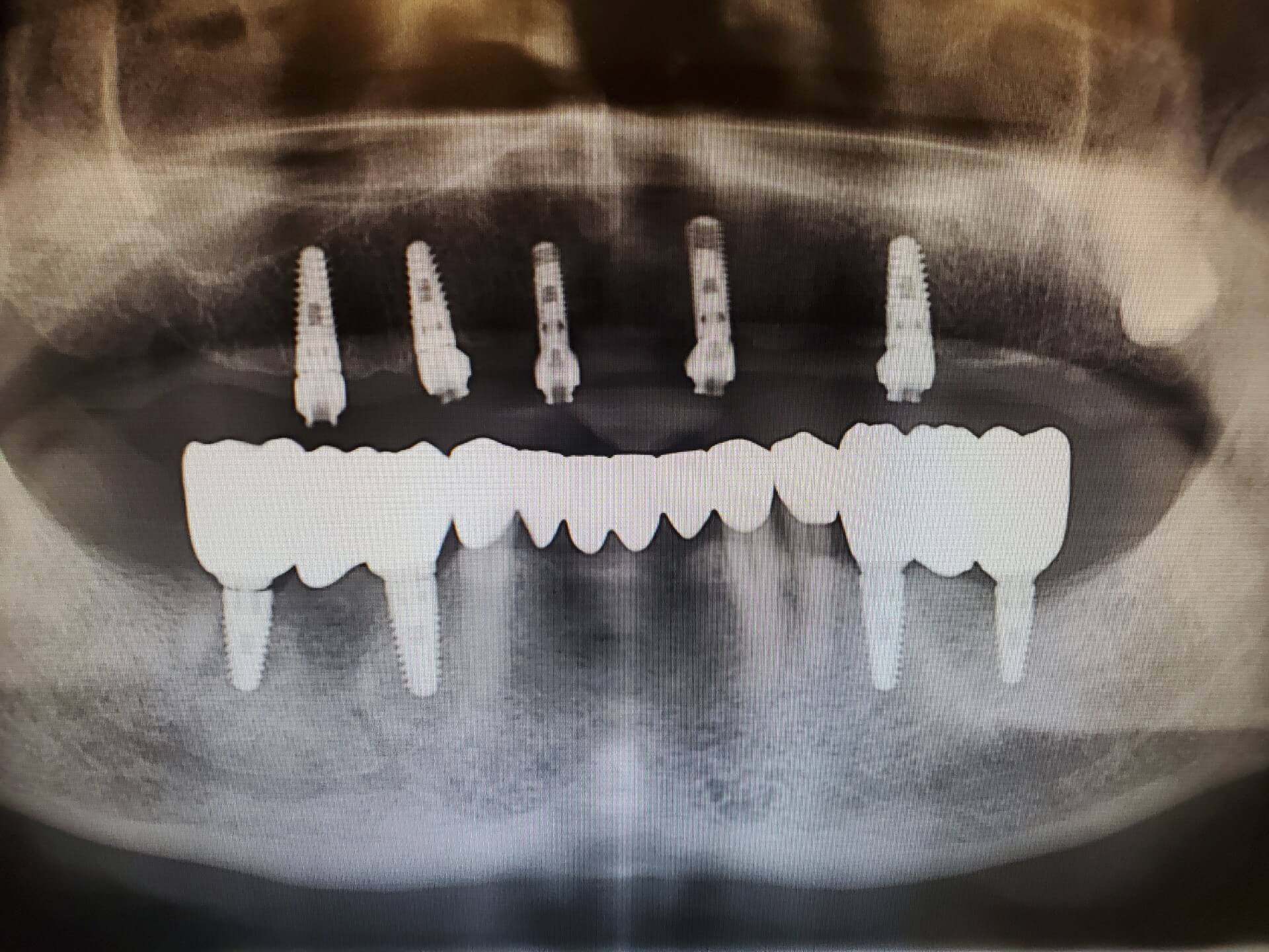 All-on-X full-arch implant bridge case 2 — before and after treatment at Terrell Hills Dental in San Antonio, TX