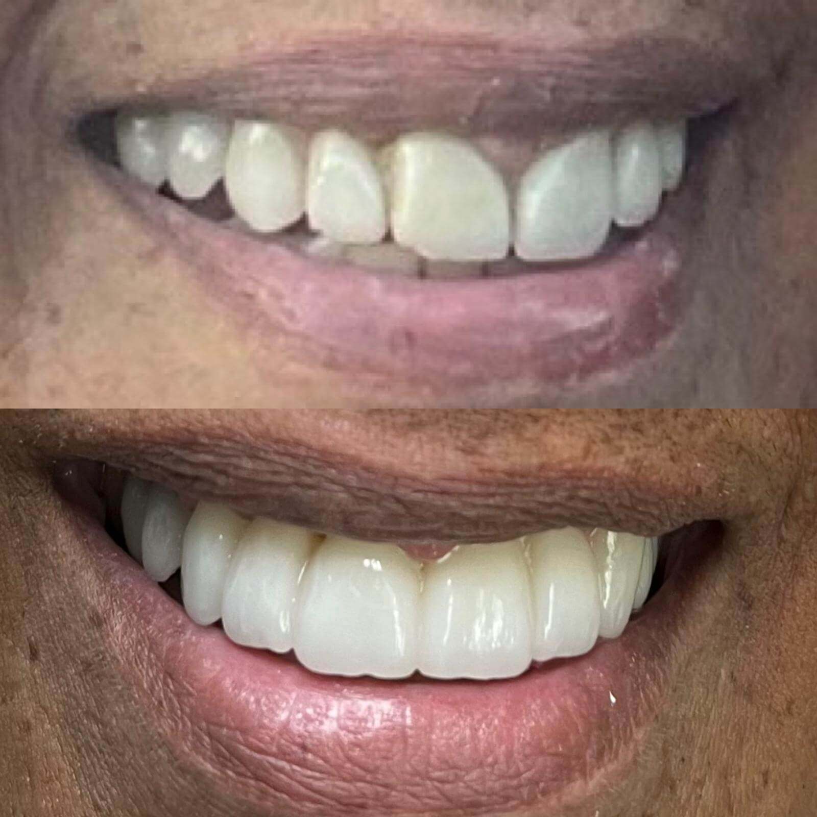 All-on-X full-arch implant bridge case 3 — before and after treatment at Terrell Hills Dental in San Antonio, TX