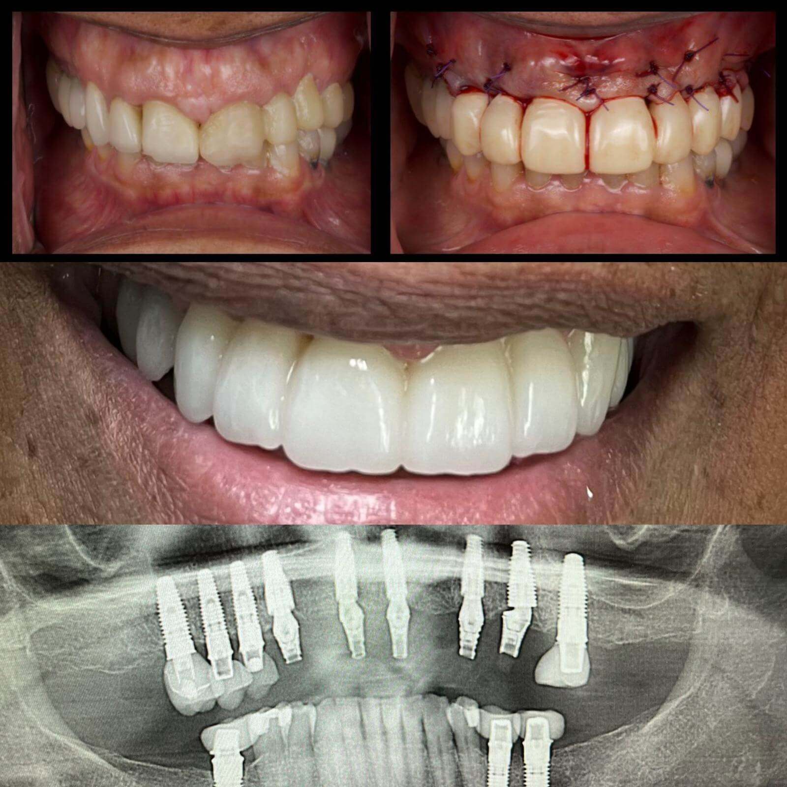 All-on-X full-arch implant bridge case 4 — before and after treatment at Terrell Hills Dental in San Antonio, TX
