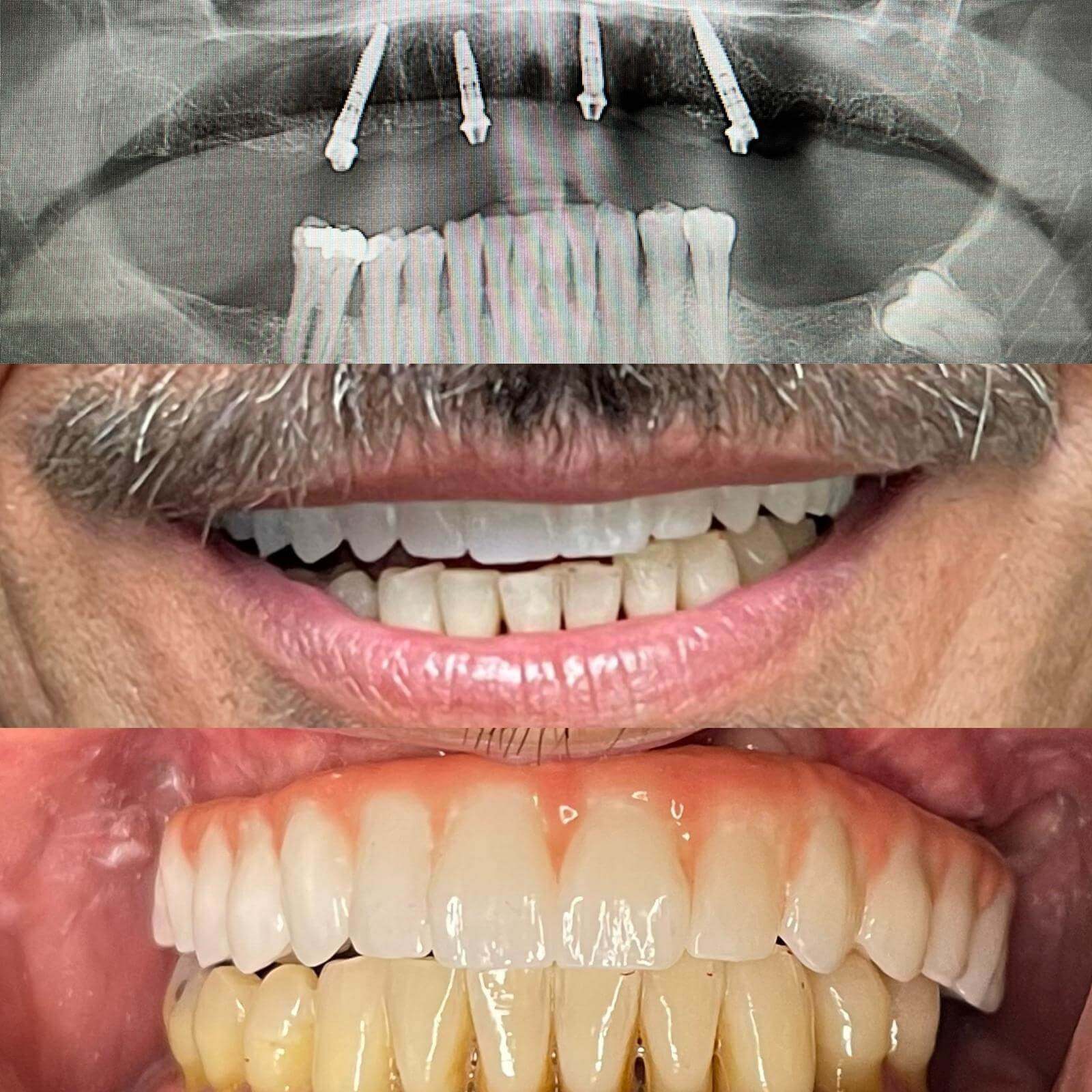 All-on-X full-arch implant bridge case 5 — before and after treatment at Terrell Hills Dental in San Antonio, TX