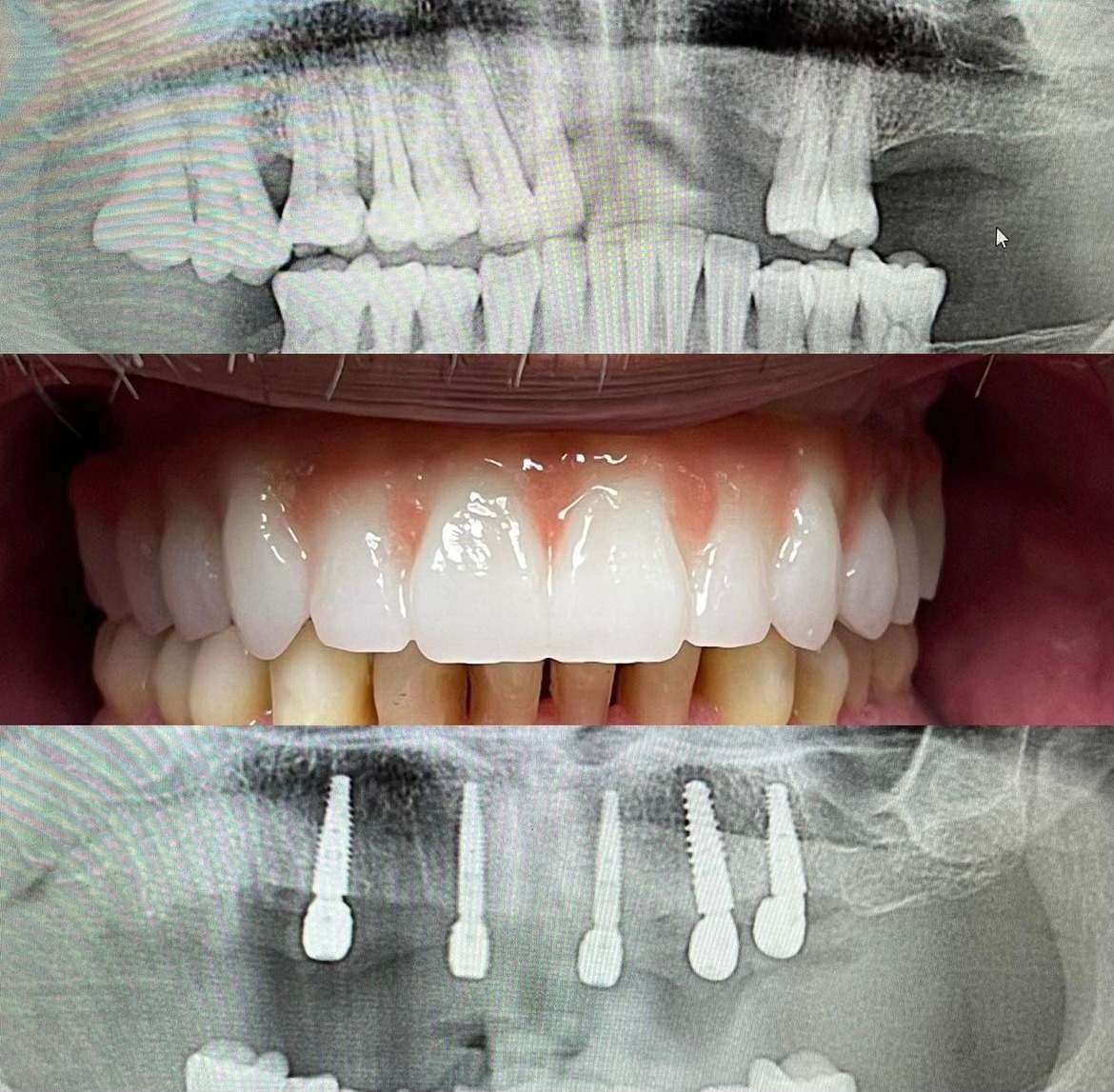 All-on-X full-arch implant bridge case 6 — before and after treatment at Terrell Hills Dental in San Antonio, TX