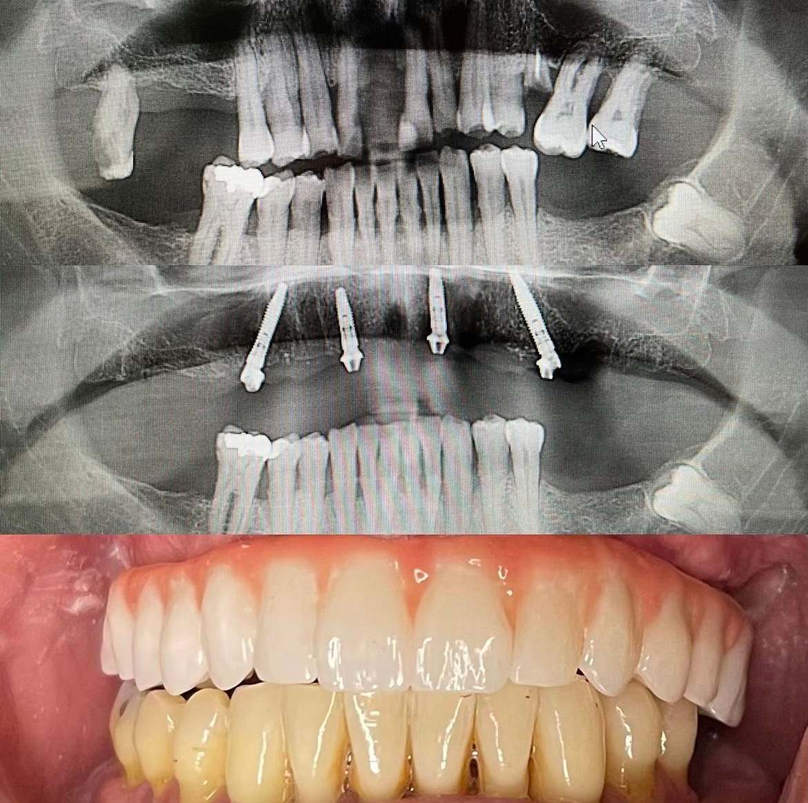 All-on-X full-arch implant bridge case 7 — before and after treatment at Terrell Hills Dental in San Antonio, TX