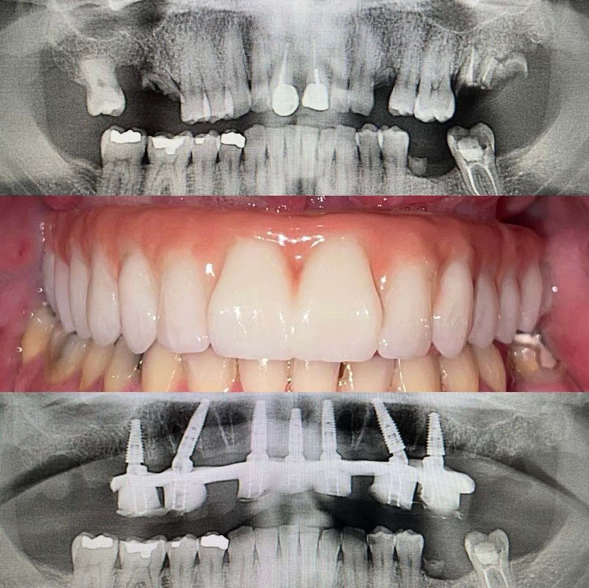 All-on-X full-arch implant bridge case 8 — before and after treatment at Terrell Hills Dental in San Antonio, TX
