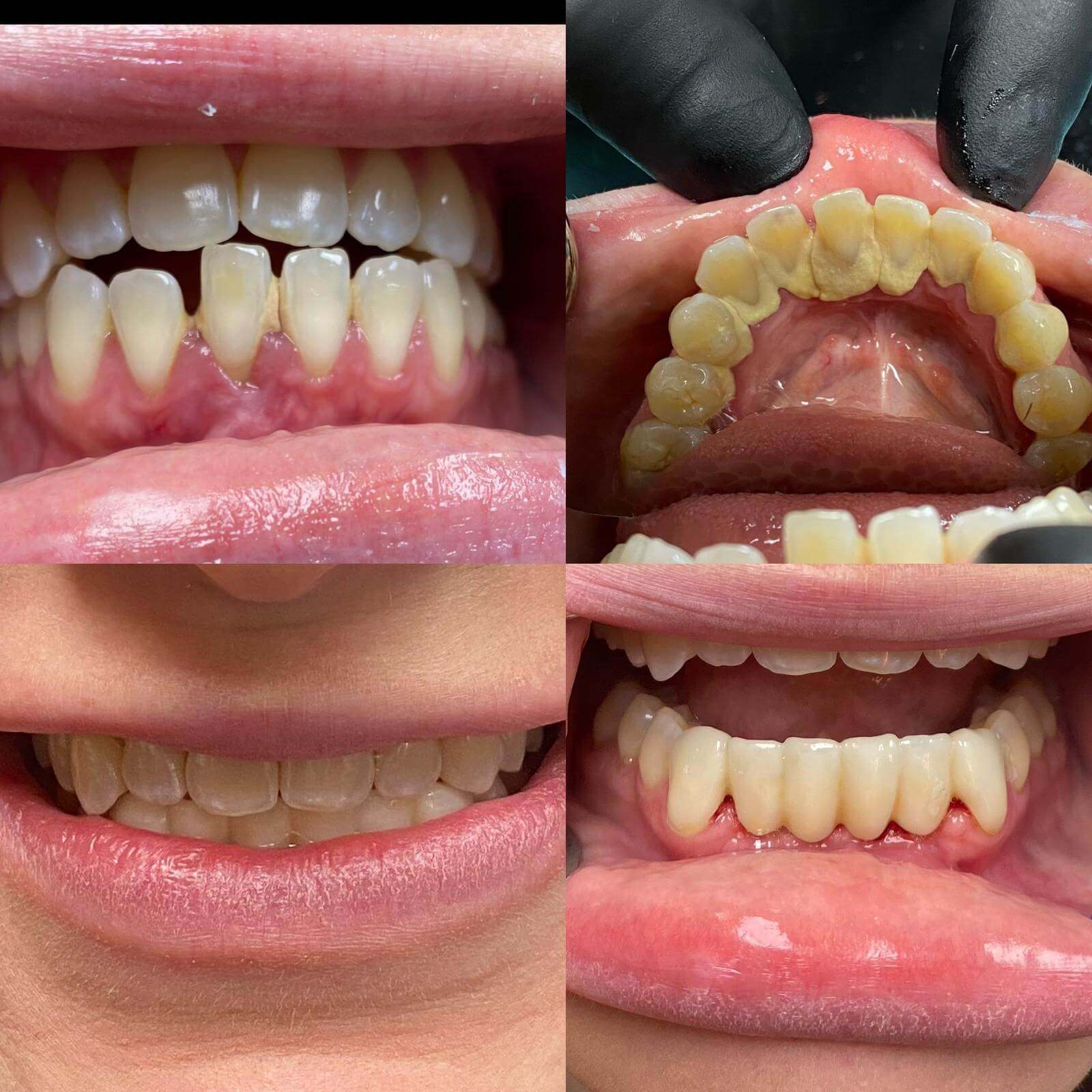 Dental bridge case 1 — missing tooth before and after treatment at Terrell Hills Dental in San Antonio, TX