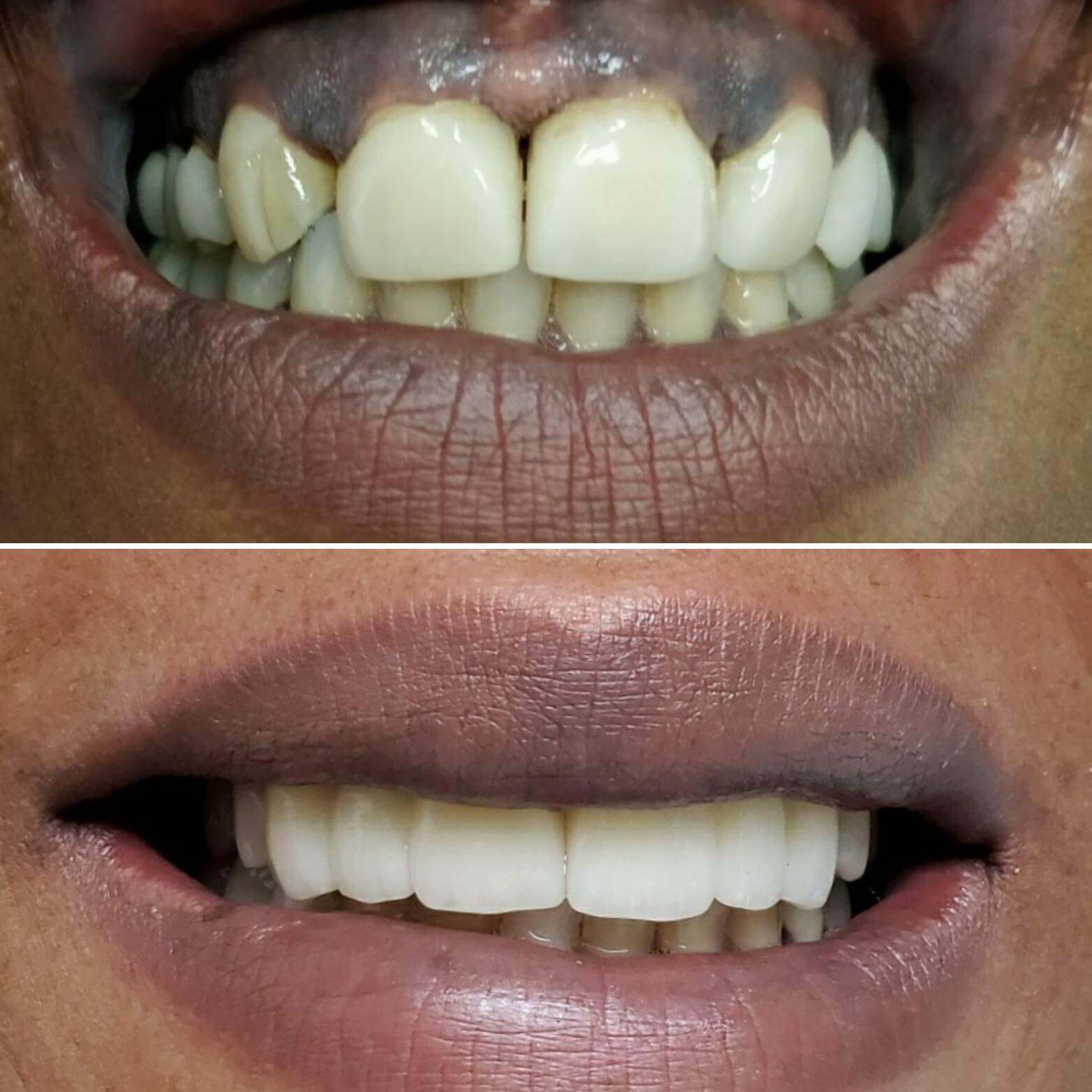 Dental bridge case 2 — missing tooth before and after treatment at Terrell Hills Dental in San Antonio, TX