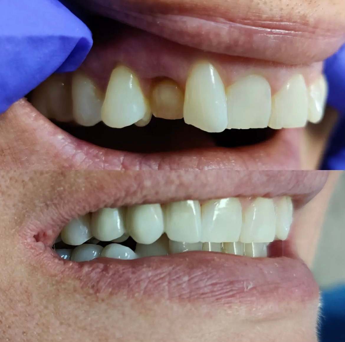 Dental bridge case 3 — missing tooth before and after treatment at Terrell Hills Dental in San Antonio, TX
