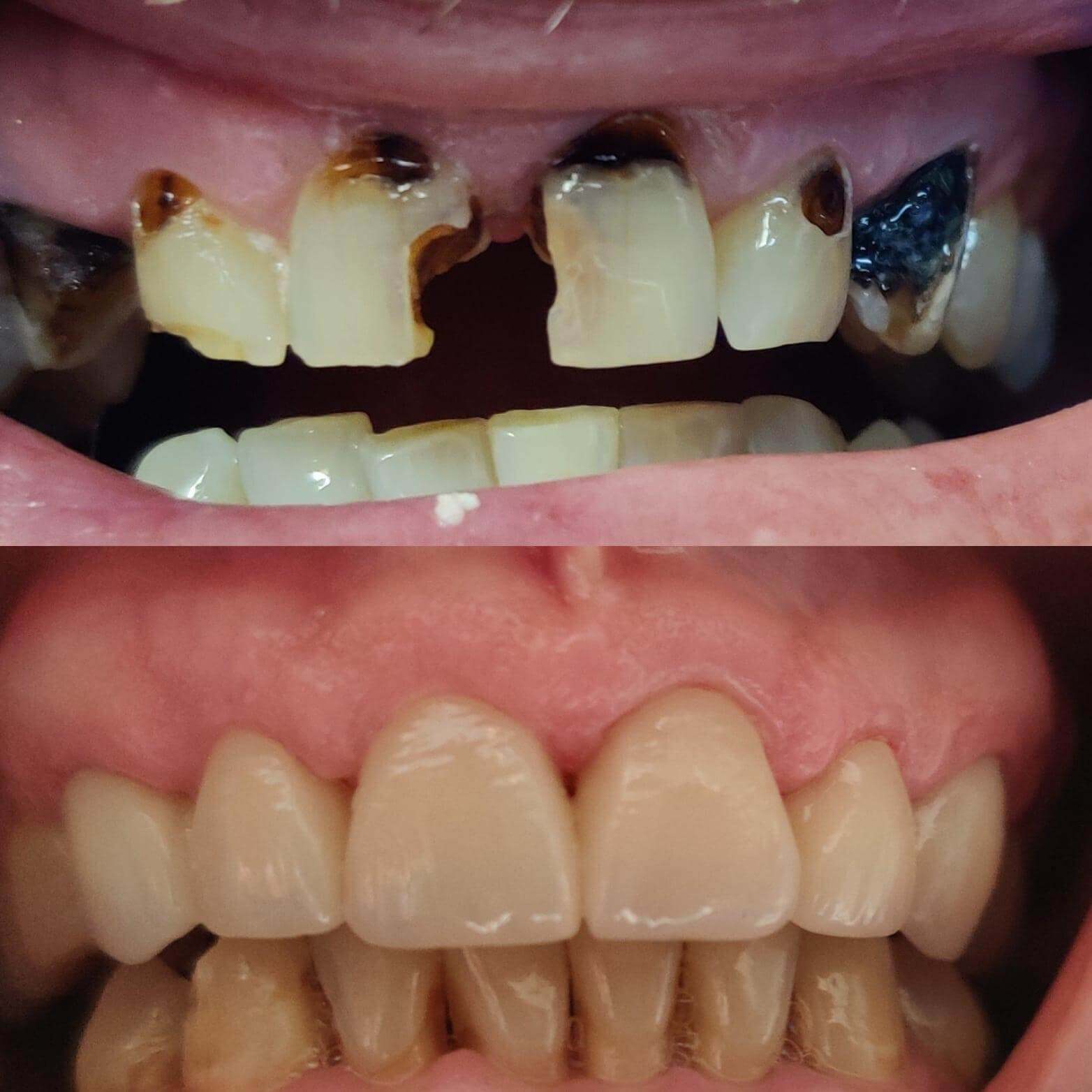 Dental crown case 1 — damaged tooth before and after restoration at Terrell Hills Dental in San Antonio, TX