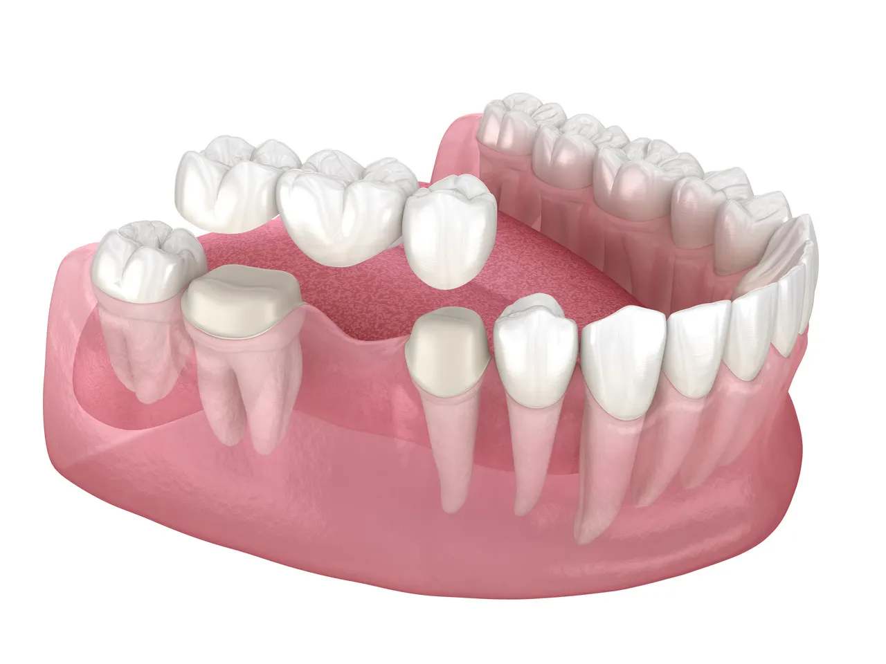 Dental Bridges at Terrell Hills Dental in San Antonio