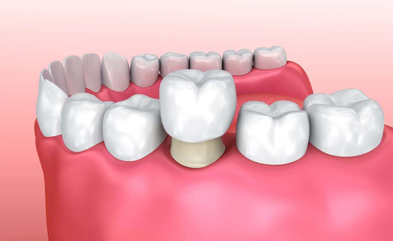 Dental Crowns at Terrell Hills Dental in San Antonio