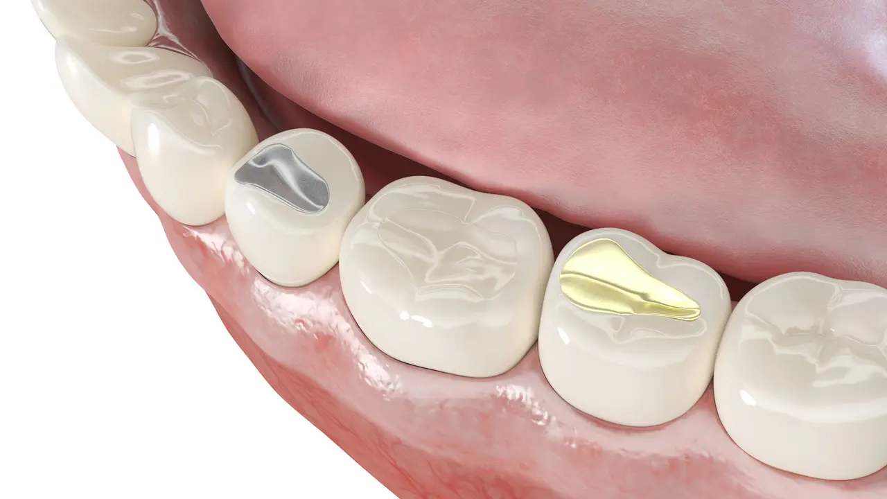 Dental Fillings at Terrell Hills Dental in San Antonio