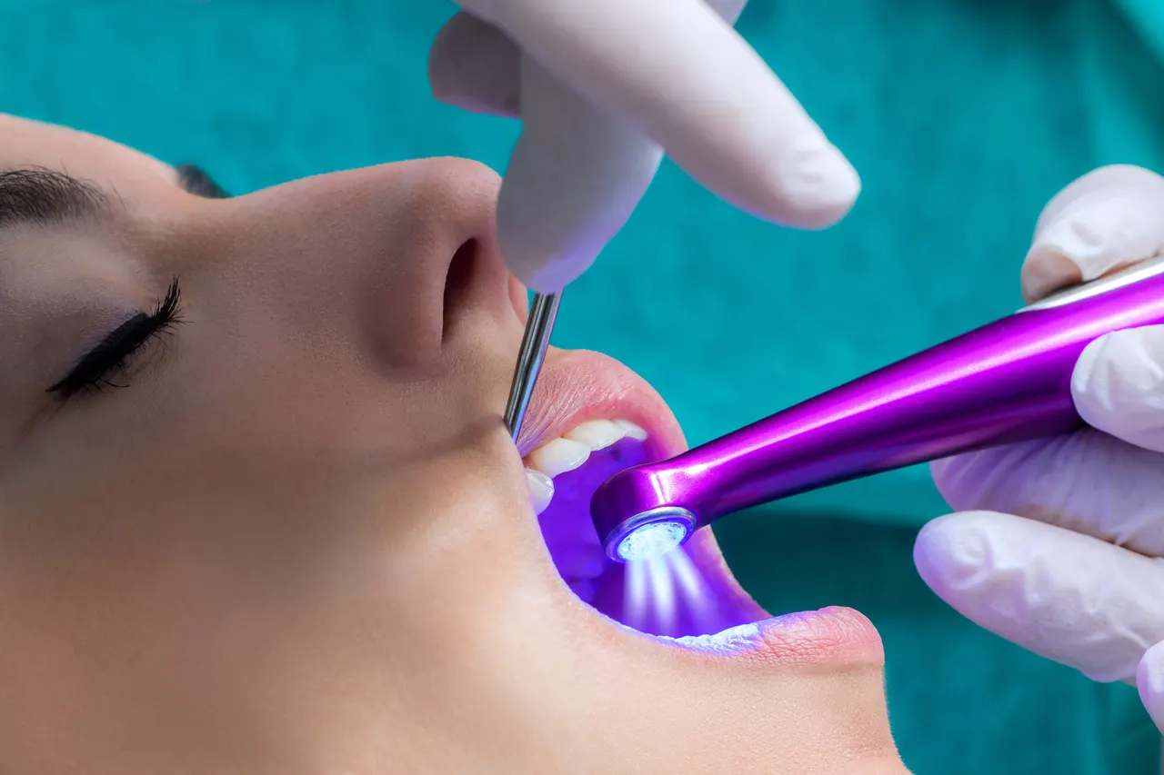 Dental Sealants at Terrell Hills Dental in San Antonio