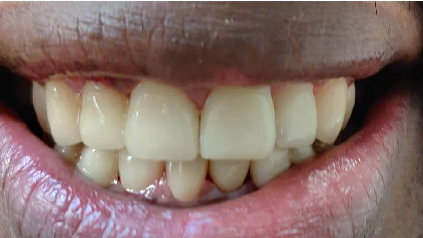 A finished veneer and crown case completed at Terrell Hills Dental in San Antonio, TX