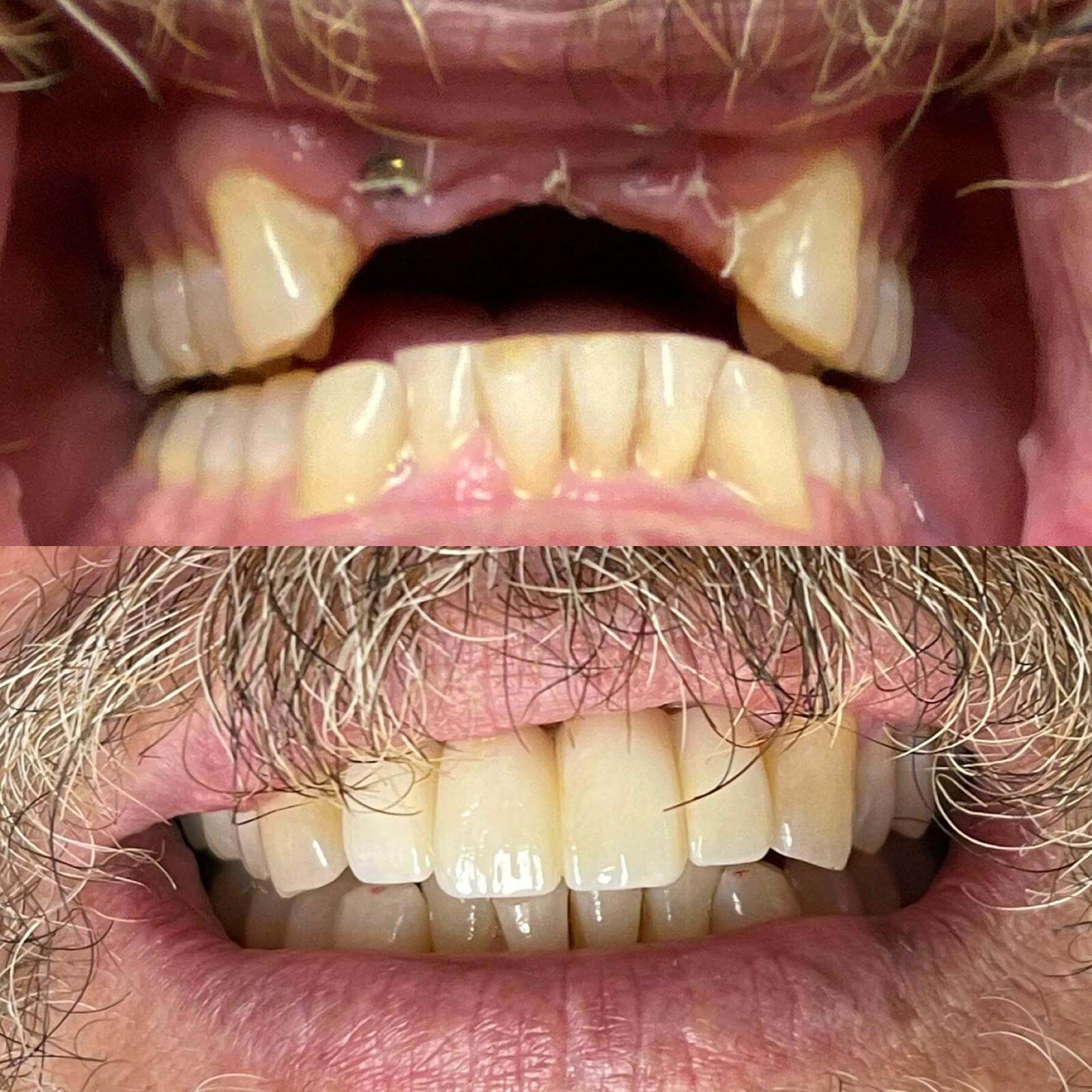 Implant-supported bridge case 1 — before and after treatment at Terrell Hills Dental in San Antonio, TX