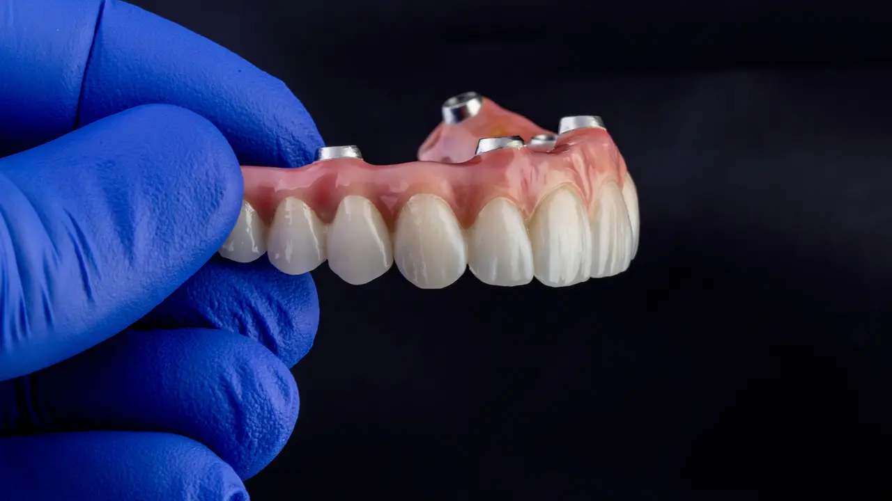 Implant Overdentures at Terrell Hills Dental in San Antonio