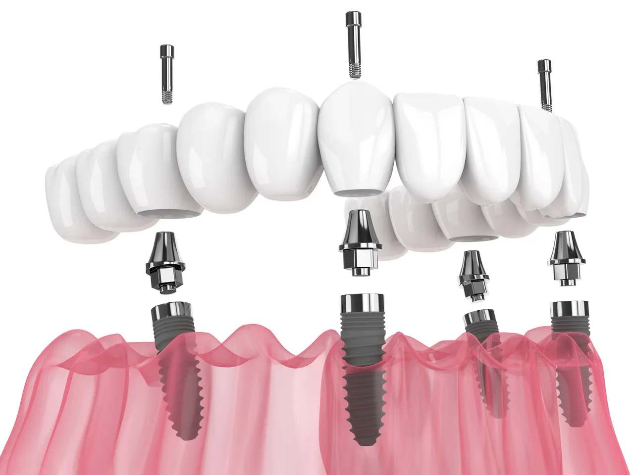 Full Mouth Dental Implants at Terrell Hills Dental in San Antonio