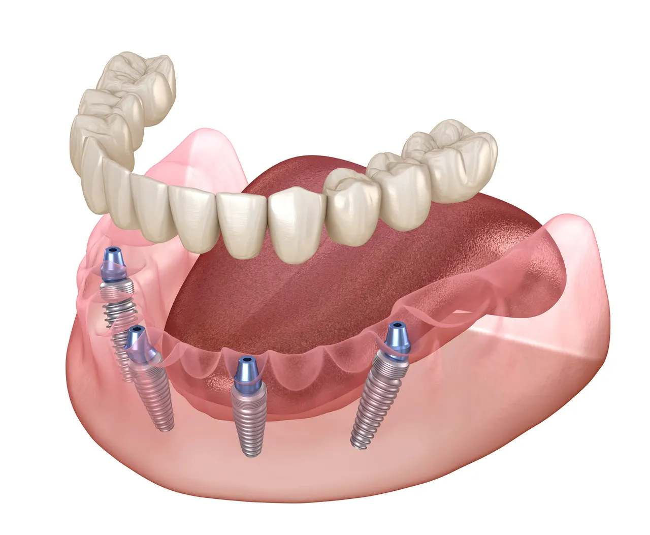 Implant-Supported Dentures at Terrell Hills Dental in San Antonio