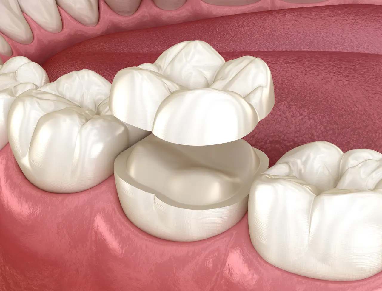 Inlays & Onlays at Terrell Hills Dental in San Antonio
