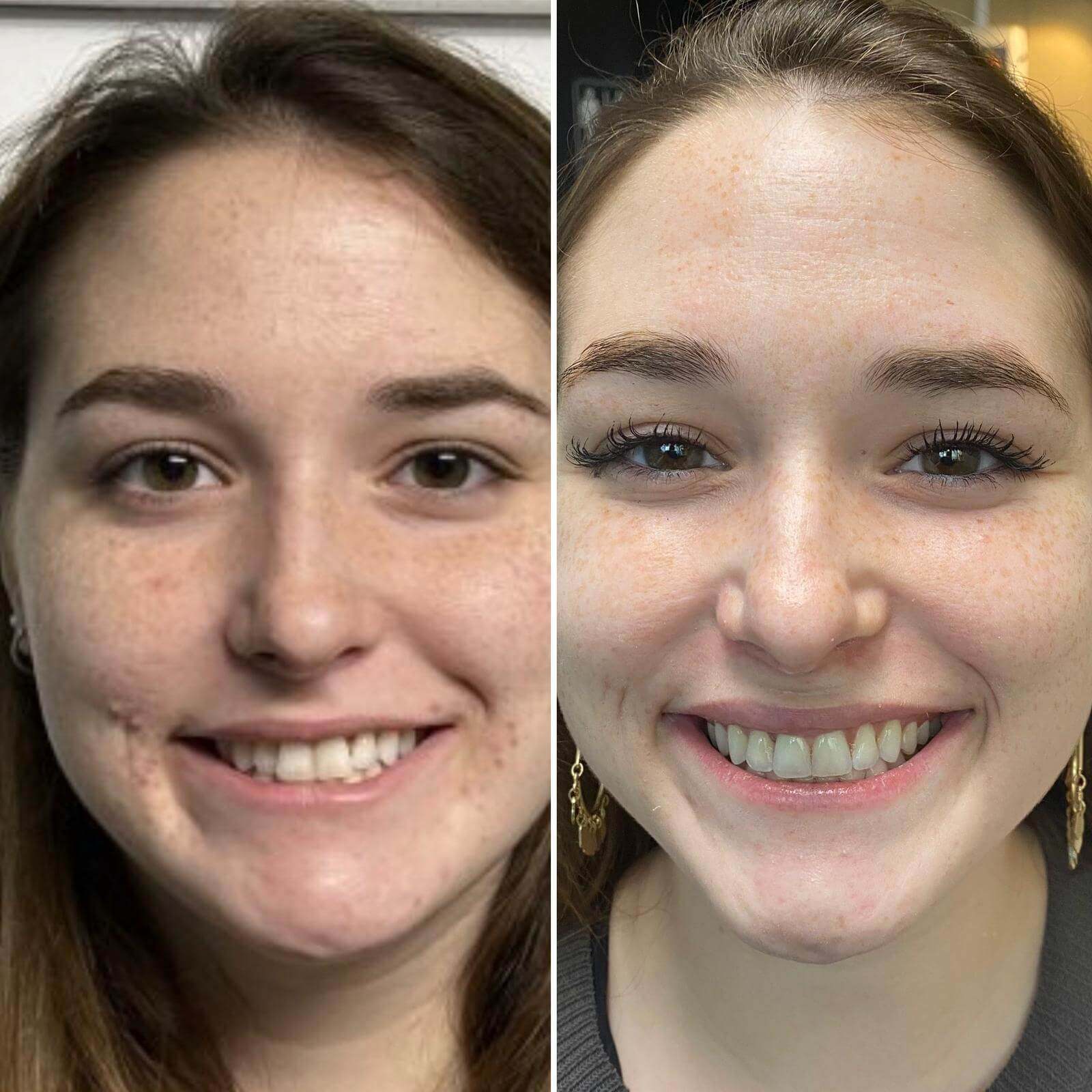 Invisalign clear aligner case 1 — teeth before and after treatment at Terrell Hills Dental in San Antonio, TX