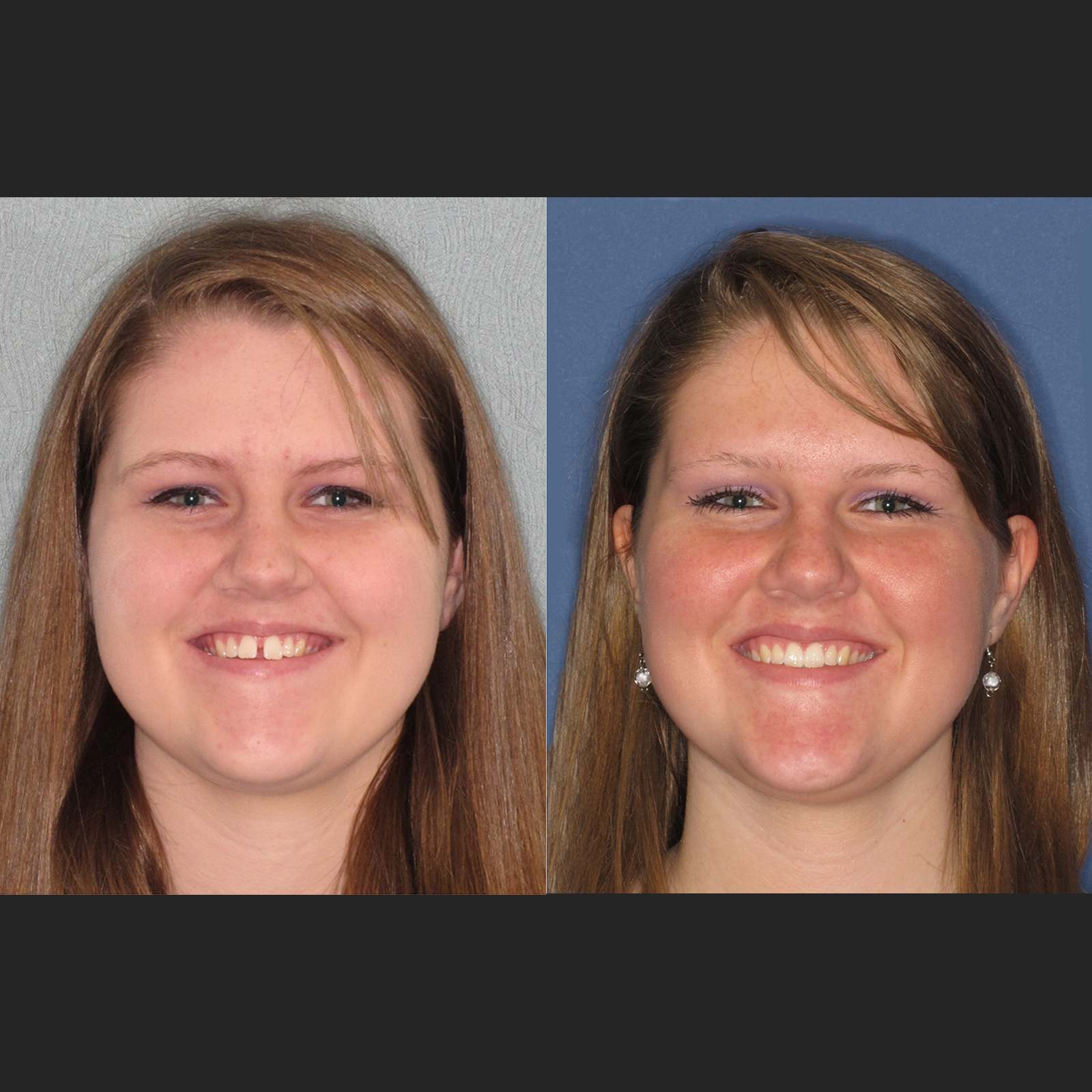 Invisalign clear aligner case 2 — teeth before and after treatment at Terrell Hills Dental in San Antonio, TX