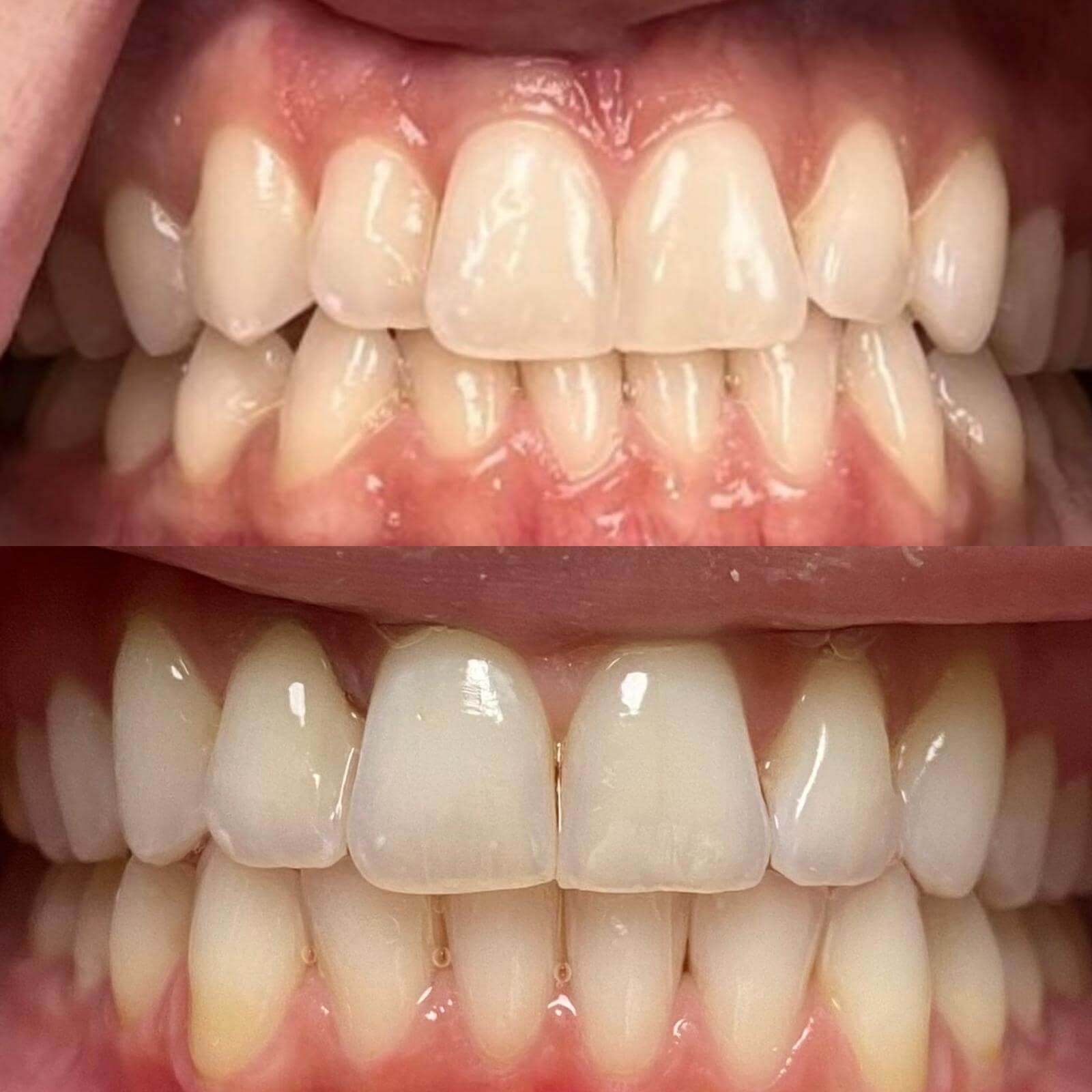 Invisalign clear aligner case 4 — teeth before and after treatment at Terrell Hills Dental in San Antonio, TX