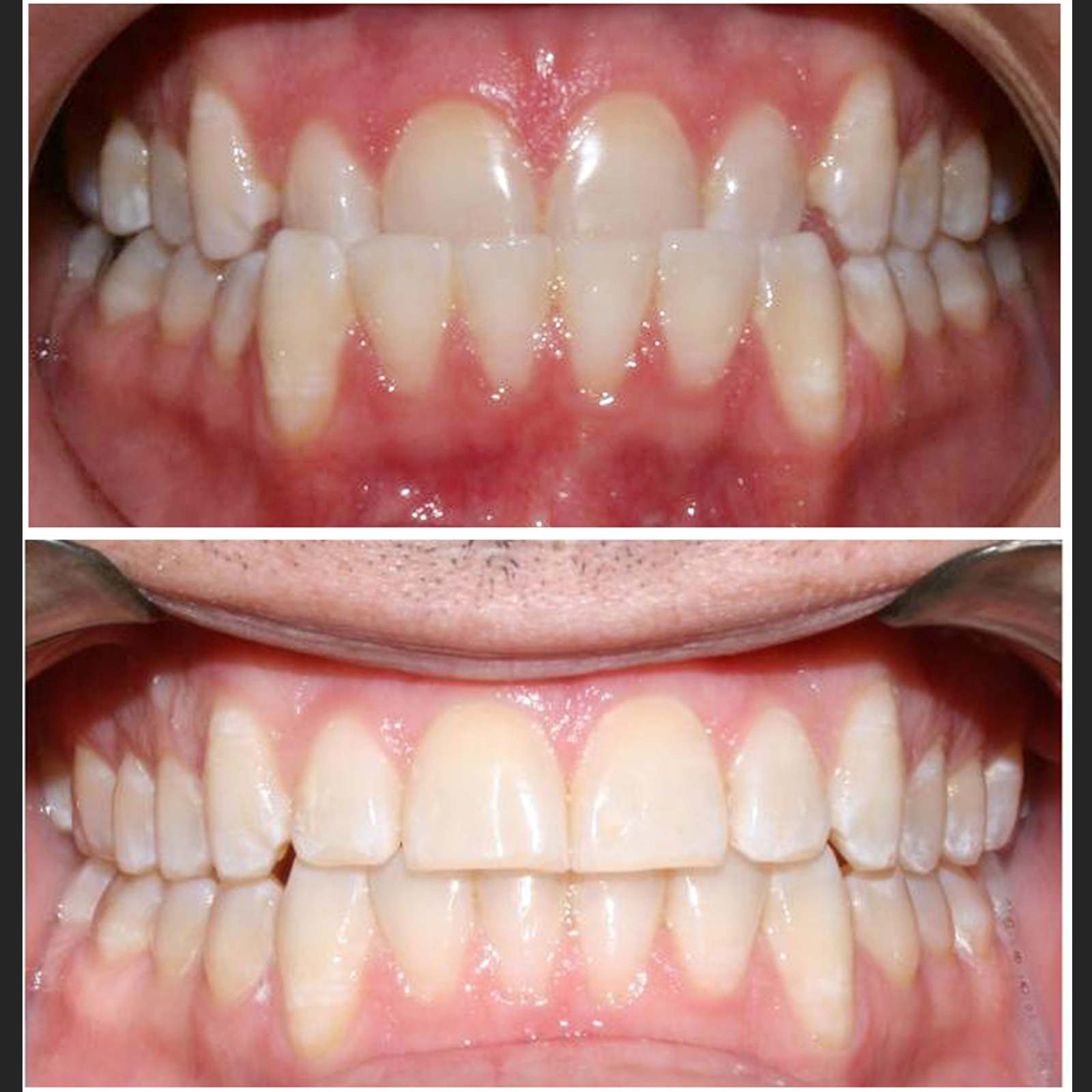 Invisalign clear aligner case 5 — teeth before and after treatment at Terrell Hills Dental in San Antonio, TX