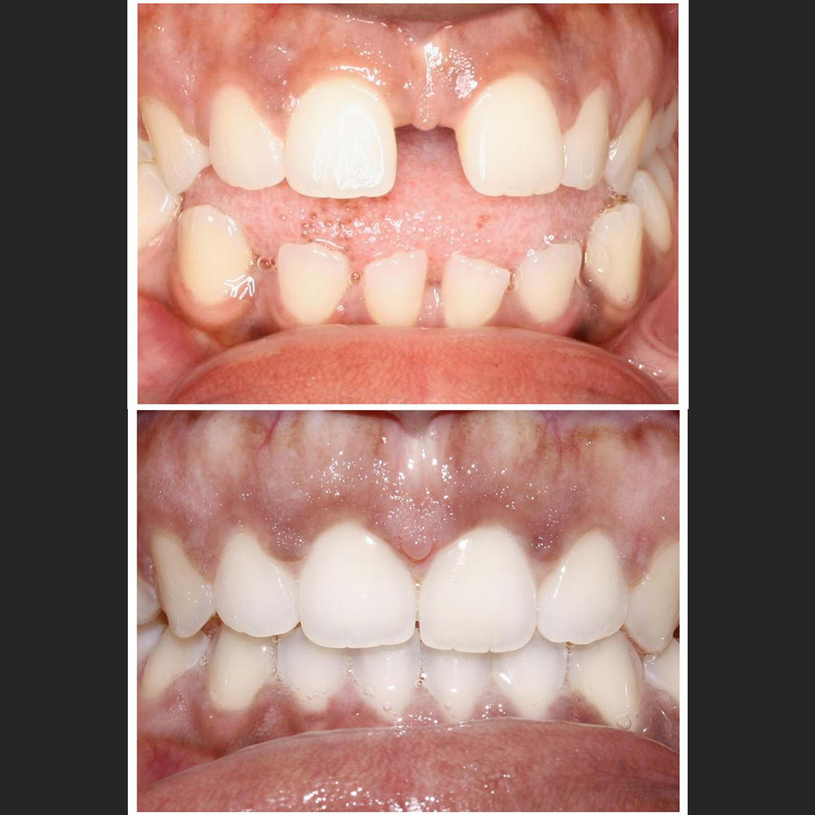 Invisalign clear aligner case 6 — teeth before and after treatment at Terrell Hills Dental in San Antonio, TX