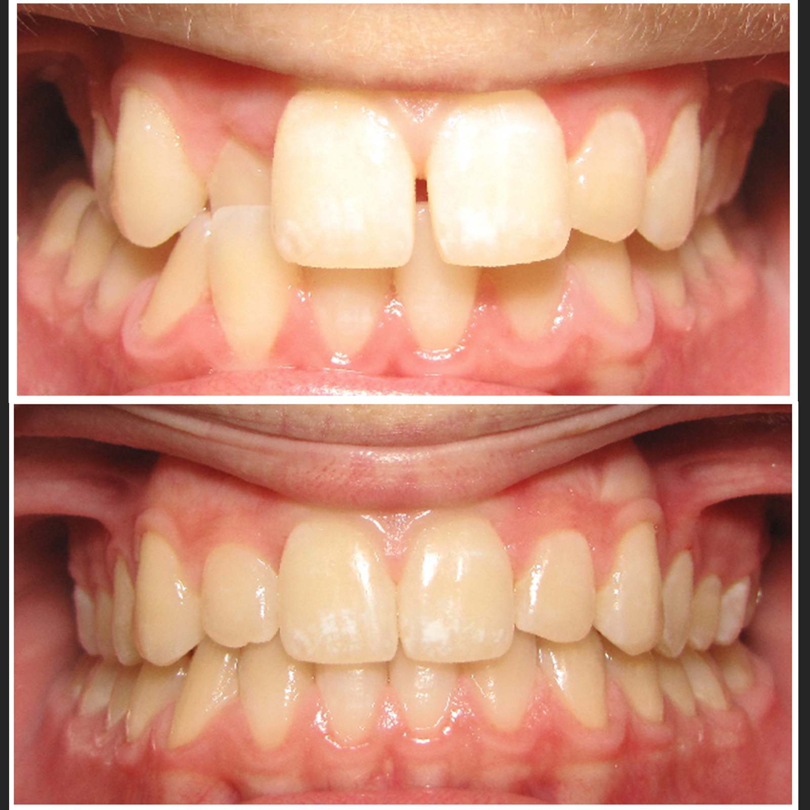 Invisalign clear aligner case 7 — teeth before and after treatment at Terrell Hills Dental in San Antonio, TX
