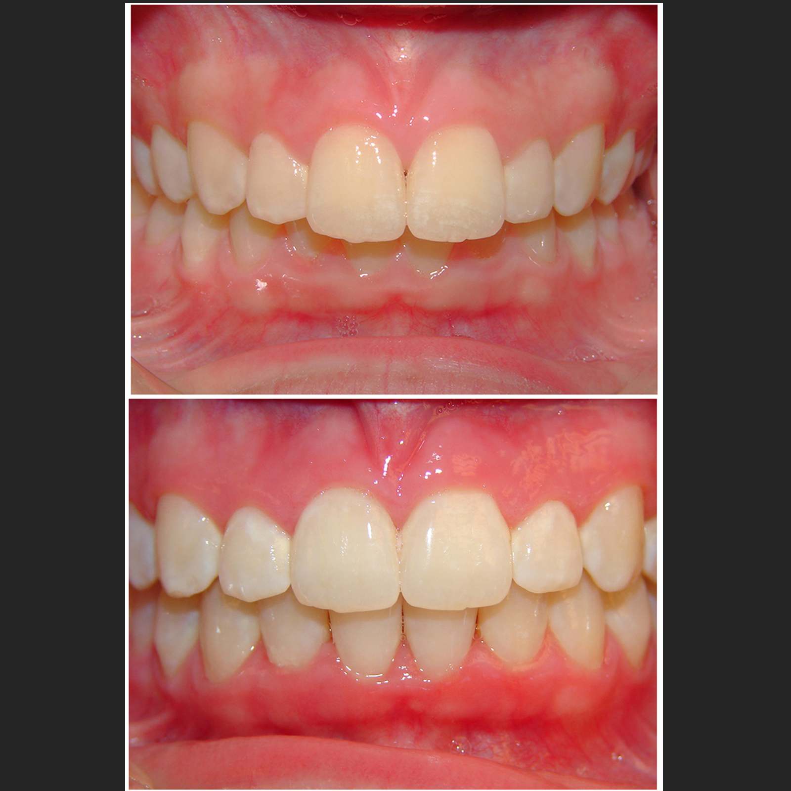 Invisalign clear aligner case 8 — teeth before and after treatment at Terrell Hills Dental in San Antonio, TX