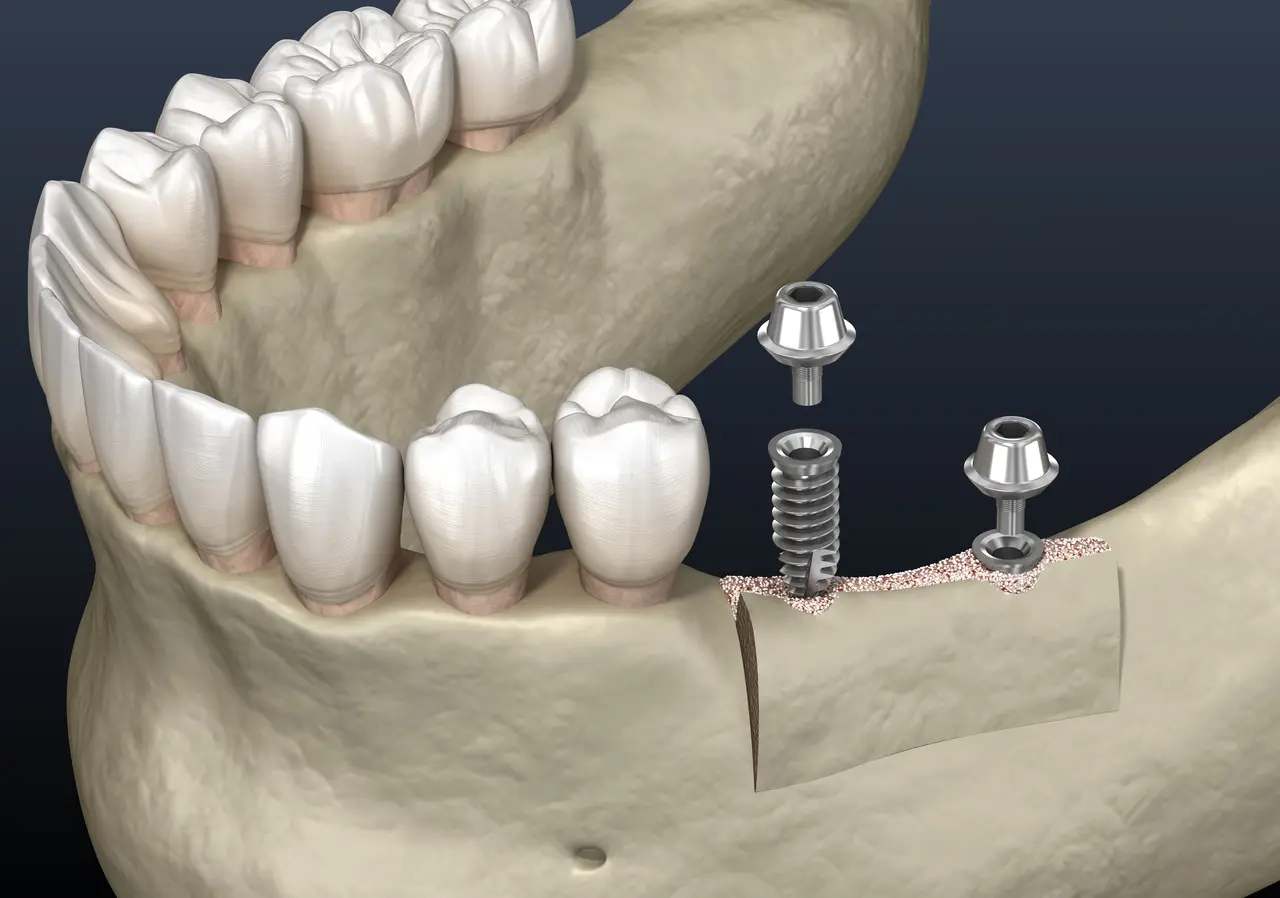 Ridge Augmentation at Terrell Hills Dental in San Antonio