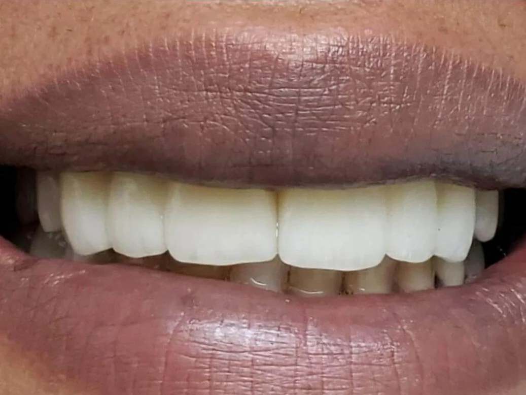 Dental Bridges at Terrell Hills Dental in San Antonio