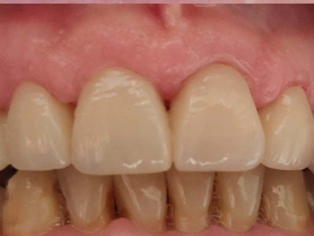Dental Crowns at Terrell Hills Dental in San Antonio