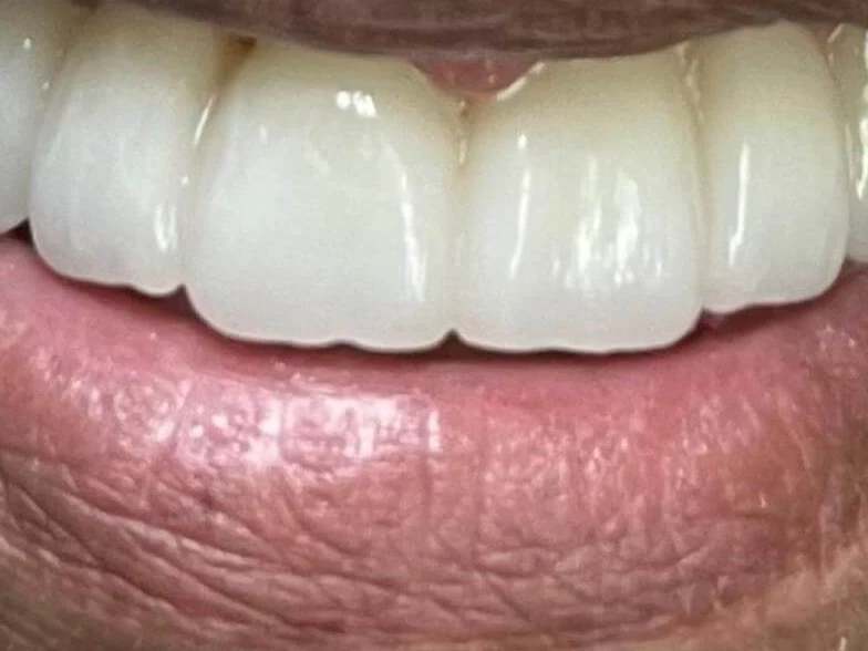 Full Mouth Dental Implants at Terrell Hills Dental in San Antonio