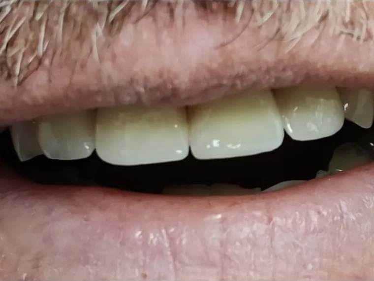 Dental Laminates at Terrell Hills Dental in San Antonio