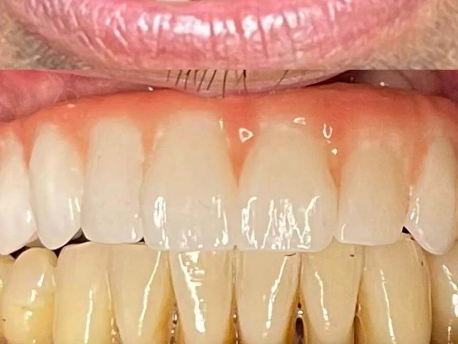 Implant Overdentures at Terrell Hills Dental in San Antonio