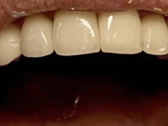 Prepless Veneers / Lumineers at Terrell Hills Dental in San Antonio
