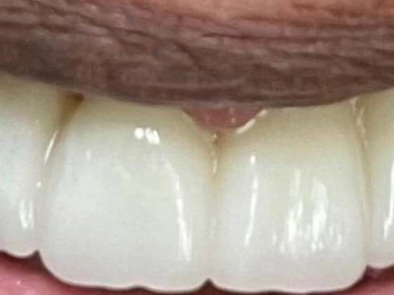Smile Makeover at Terrell Hills Dental in San Antonio