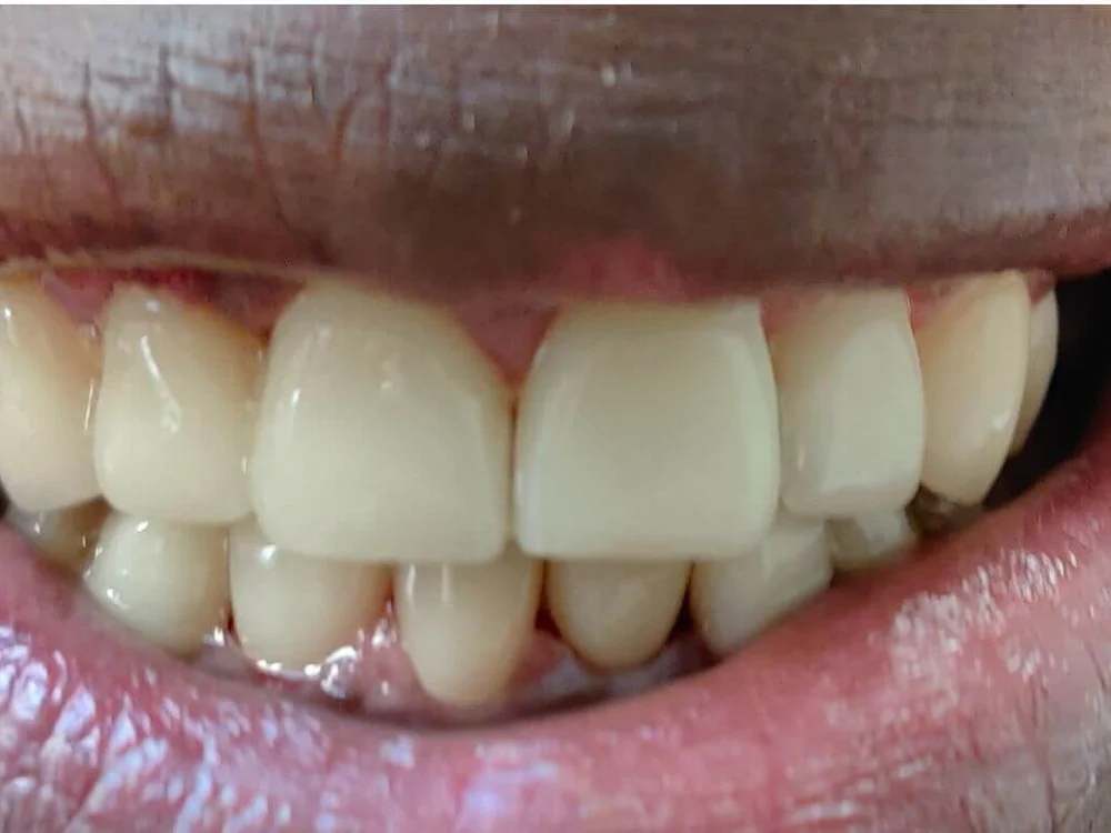 Porcelain Veneers at Terrell Hills Dental in San Antonio