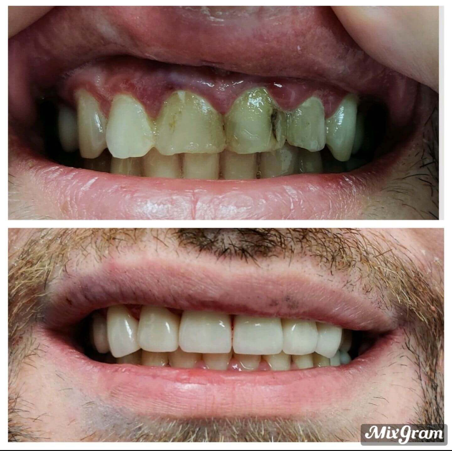 Porcelain veneers case 1 — smile before and after treatment at Terrell Hills Dental in San Antonio, TX