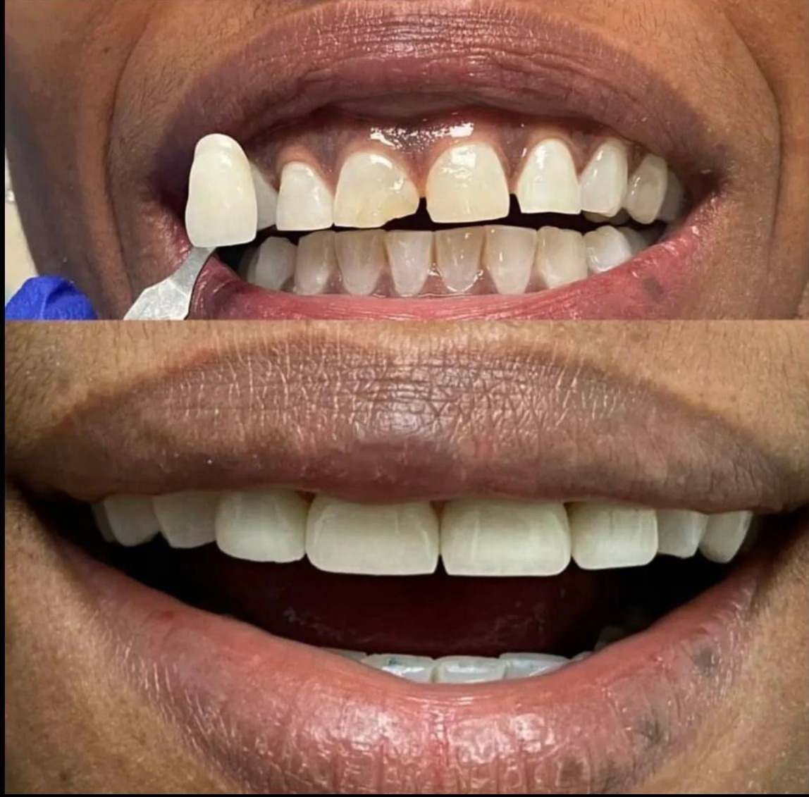 Porcelain veneers case 2 — smile before and after treatment at Terrell Hills Dental in San Antonio, TX
