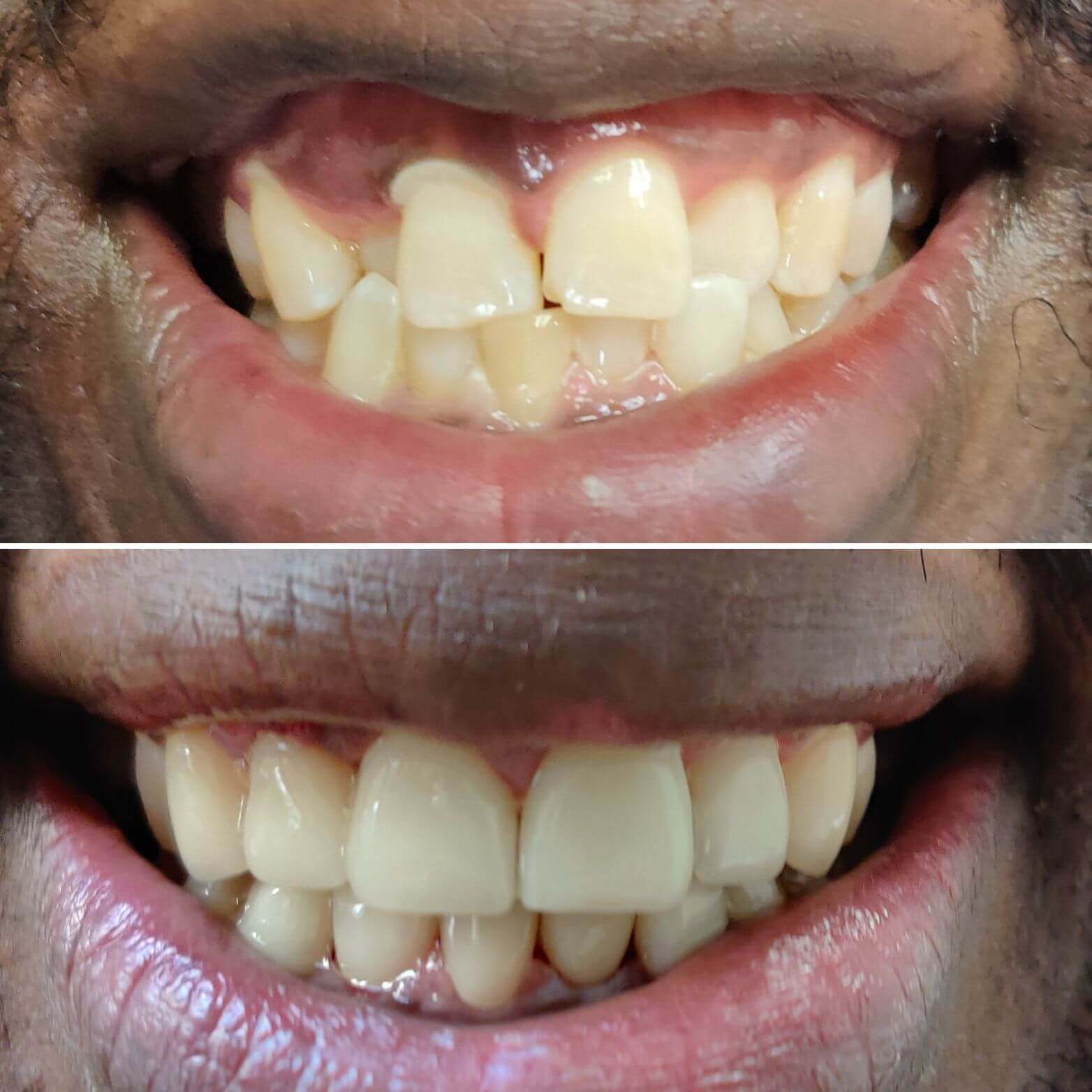Combined veneers and crowns case 1 — smile before and after treatment at Terrell Hills Dental in San Antonio, TX