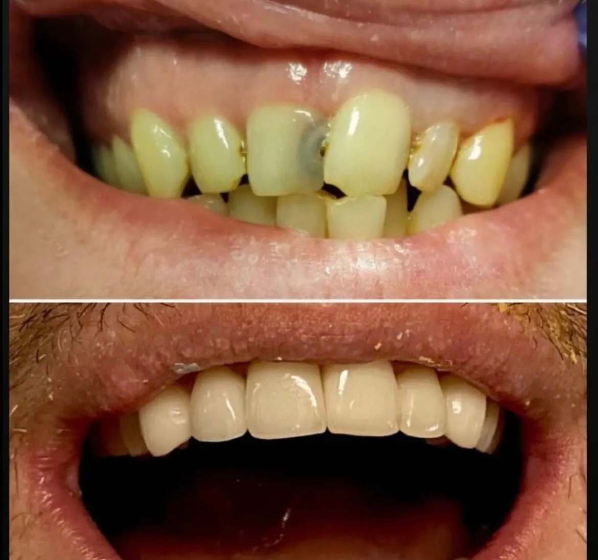 Combined veneers and crowns case 2 — smile before and after treatment at Terrell Hills Dental in San Antonio, TX