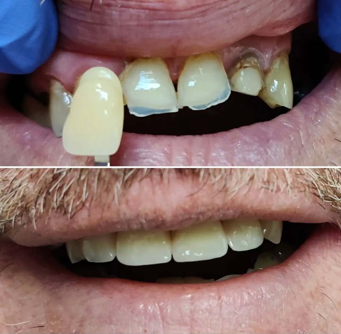 Combined veneers and crowns case 3 — smile before and after treatment at Terrell Hills Dental in San Antonio, TX