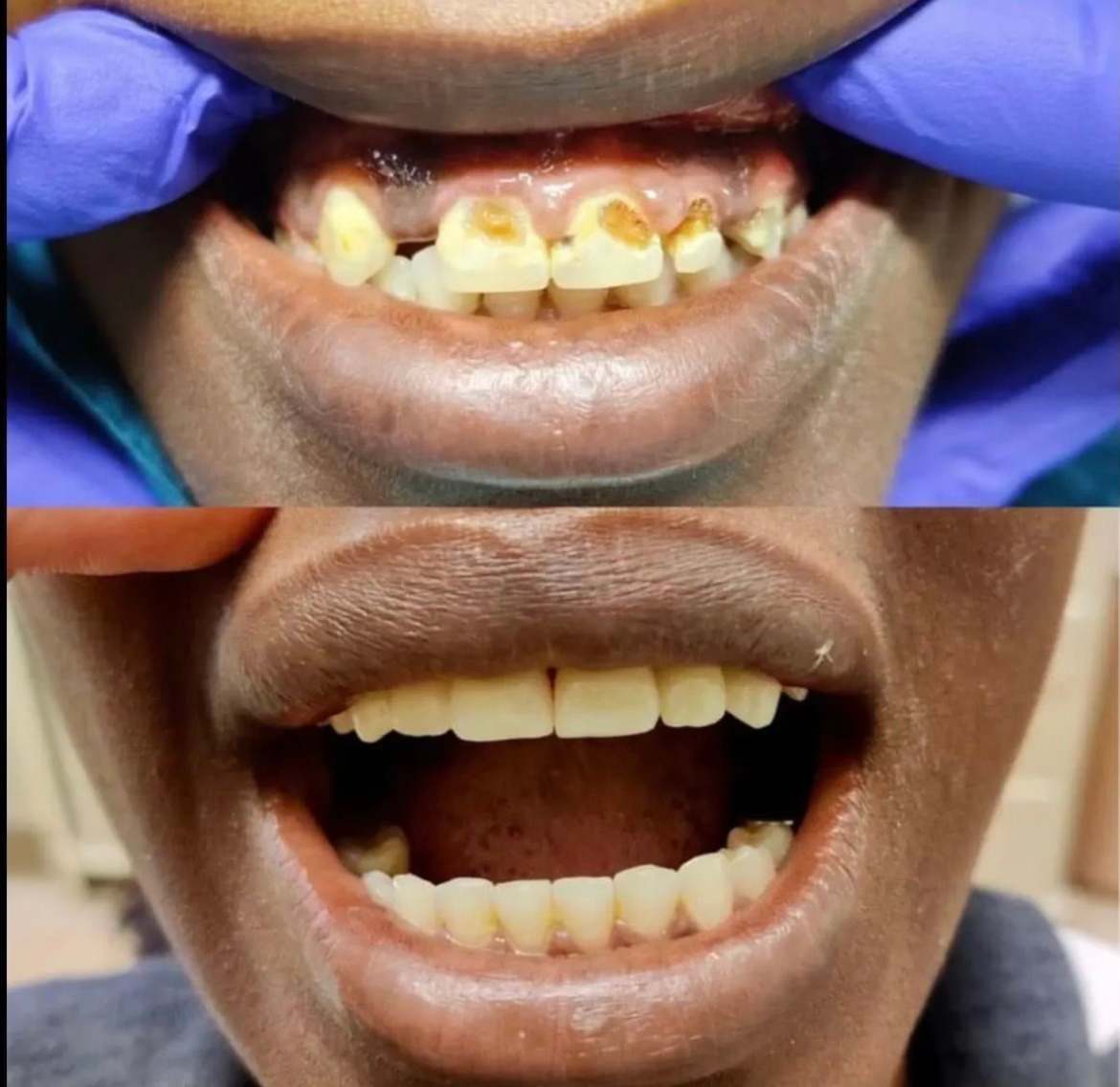 Combined veneers and crowns case 4 — smile before and after treatment at Terrell Hills Dental in San Antonio, TX